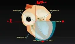 Ver e interpretar el eje cardiaco