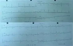 Aviso dolor precordial