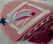 Manejo del Neumotorax aspirativo.
