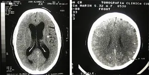 Probable- Crisis convulsiva