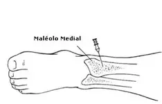 Reanimación Neonatal