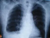 Radiolocura 3: Varón de 52 años con dolor torácico y disnea