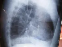 Radiolocura 3: Varón de 52 años con dolor torácico y disnea