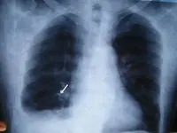 Radiolocura 3: Varón de 52 años con dolor torácico y disnea