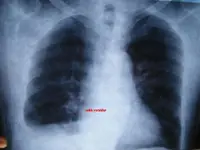 Radiolocura 3: Varón de 52 años con dolor torácico y disnea