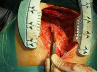 Radiolocura 3: Varón de 52 años con dolor torácico y disnea
