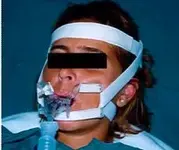 Fijación de Tubos Endotraqueales.