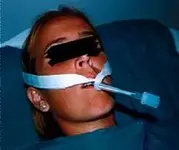 Fijación de Tubos Endotraqueales.
