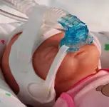 R.N. (Recien Nacido)  con cianosis corporal total
