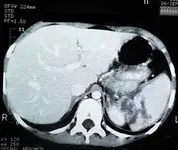Niña de 9 años trauma de abdomen