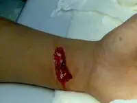accidentes con amoladoras