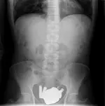 Dolor abdominal en enfermo dual.