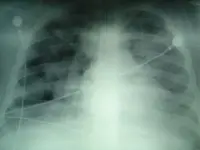 Influenza porcina (Gripe A)