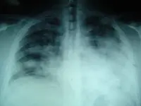 Influenza porcina (Gripe A)