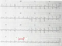 Ecg nº1 del curso para principiantes