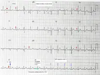 Ecg nº1 del curso para principiantes