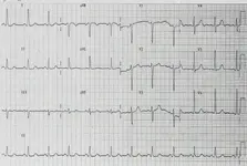 Ecg nº2 del curso para principiantes