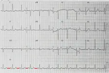 Ecg nº2 del curso para principiantes