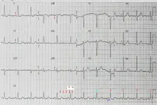Ecg nº2 del curso para principiantes