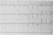 Ecg nº2 del curso para principiantes