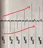 Ecg nº2 del curso para principiantes