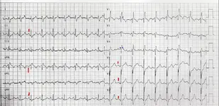Ecg nº4 para principiantes