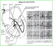 Ecg nº4 para principiantes