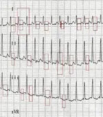 Ecg nº 8 para principiantes