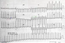 Ecg nº 8 para principiantes