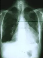 Niño de 8 años con fiebre, disnea, dolor torácico abdominal