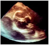 Niño de 8 años con fiebre, disnea, dolor torácico abdominal