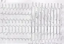 Ecg nº 9 para principiantes