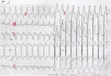 Ecg nº 9 para principiantes