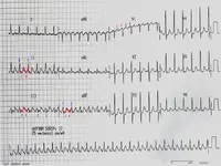Ecg nº 10 para principiantes