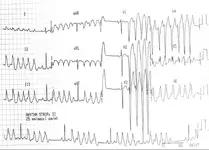 Ecg nº 18 para principiantes