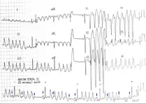 Ecg nº 18 para principiantes