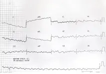 Ecg nº 21 para principiantes