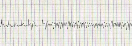 Ecg nº 21 para principiantes