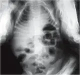 Neonato Prematuro con llanto y trastornos intestinales.