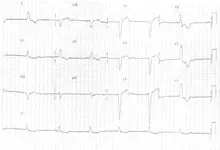 Ecg nº 22 para principiantes