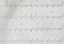Ecg nº 26 para principiantes