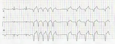Ecg nº 26 para principiantes