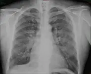Tos Hemoptoica - Disnea - Sudoración - Pérdida de peso