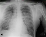 Tos Hemoptoica - Disnea - Sudoración - Pérdida de peso