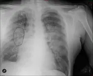 Tos Hemoptoica - Disnea - Sudoración - Pérdida de peso