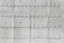 Ecg nº 36 para principiantes