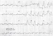 Ecg nº 37 para principiantes