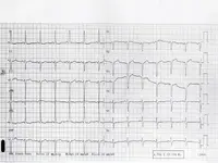 Ecg nº 38 para principiantes