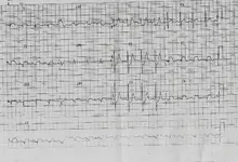 Ecg nº 39 para principiantes