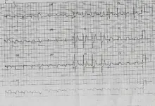 Ecg nº 39 para principiantes